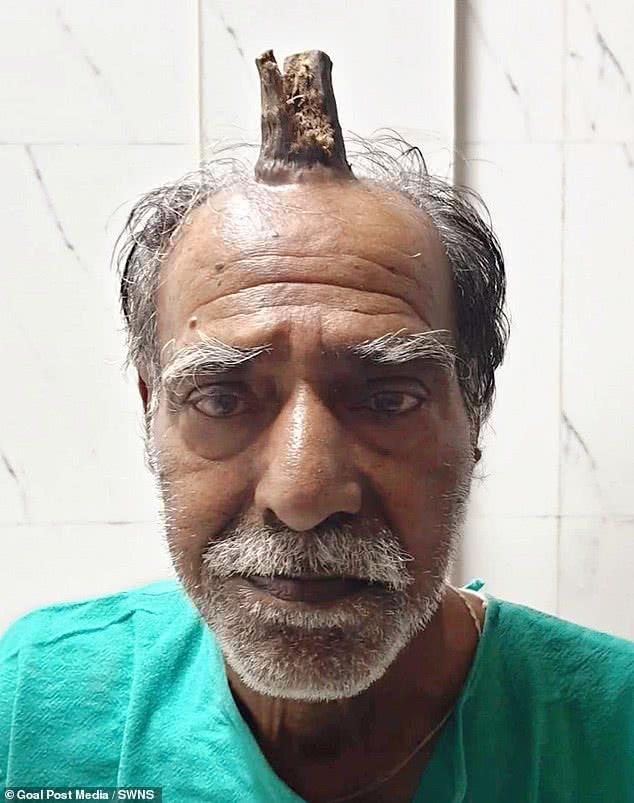 印度74岁男子头上长出10厘米"魔鬼之角",真实版"小龙人"