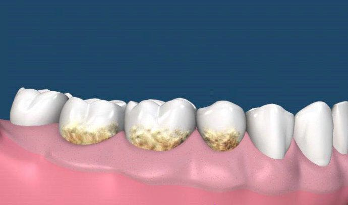 牙结石怎么自己去除?这些误区和隐患须知!