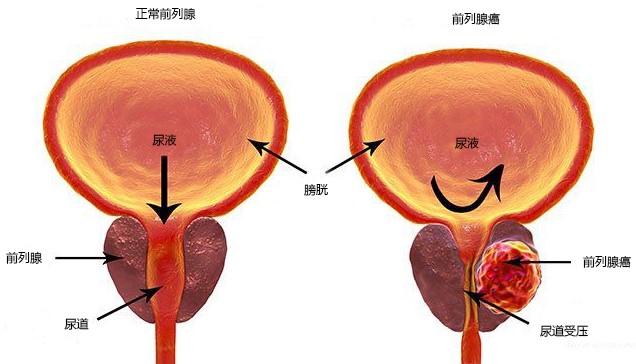 出现这些症状需警惕前列腺癌