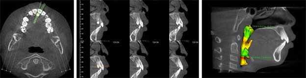 X-Rays at the Pediatric Dentist