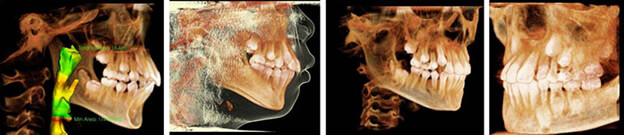 X-Rays at the Pediatric Dentist