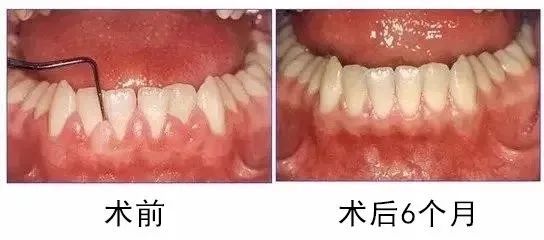 牙龈出现脓包,是什么情况?