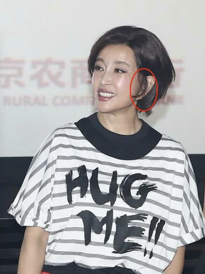 刘晓庆的耳朵怎么了