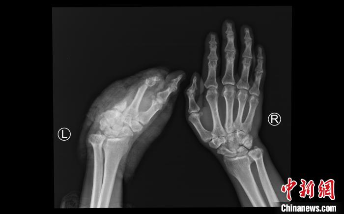 患者断掌ct影像.四川省人民医院供图