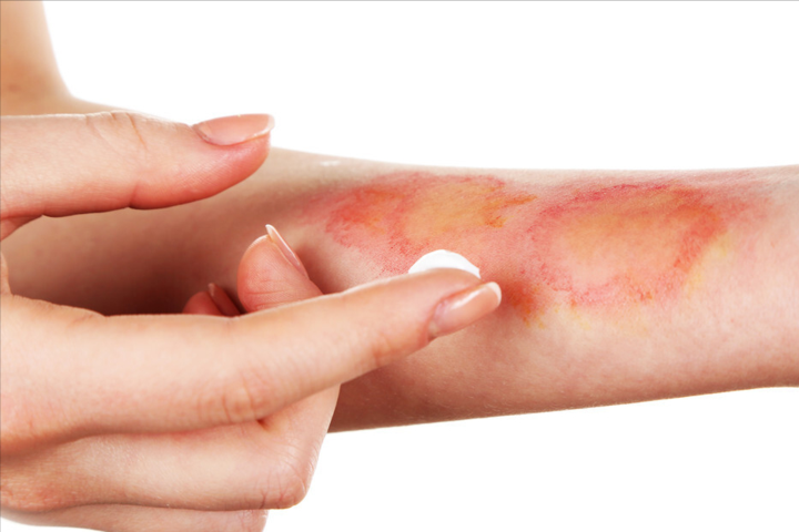 如果烫伤后马上冰敷,可能使皮肤过度降温而导致被冻伤,加重伤害