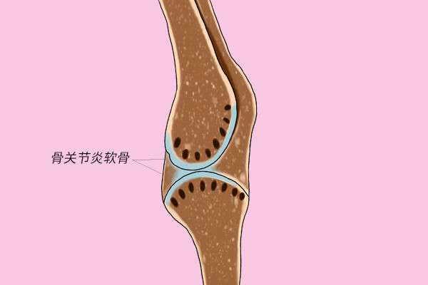 得了骨關節炎吃氨糖就行為何有人吃了有用有人吃了沒用