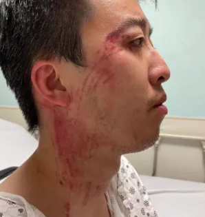 华人追尾遭对方拖出车外暴打车窗砸碎一脸血