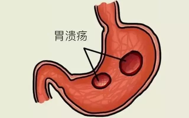 胃溃疡常见症状表现
