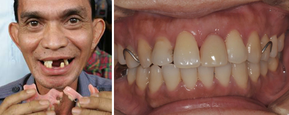 戴假牙的4大禁忌,很多人经常做