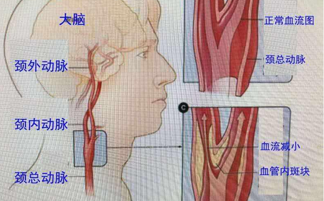 颈动脉充盈图片