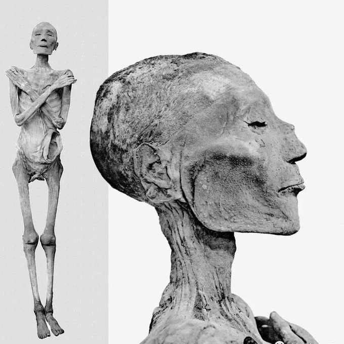 拉美西斯五世木乃伊大概率就是死于天花感染研究者认为其脸部大面积的