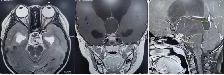 术前核磁共振检查