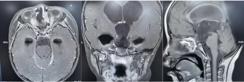 术后垂体MRI增强检查